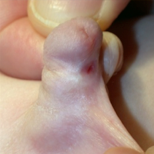 Fistula example 2