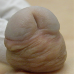 Fistula example
