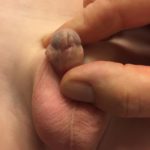 Fistula example