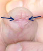 Fistula example 2