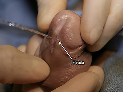 Fistula example